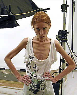 anorexia2